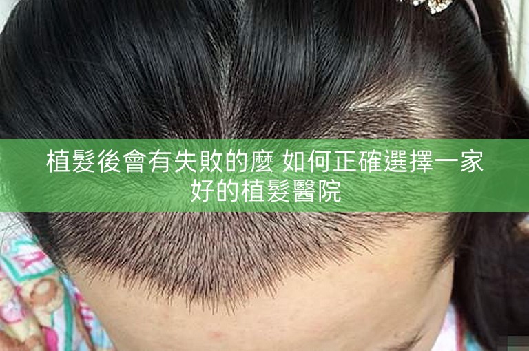 植髮後會有失敗的麼 如何正確選擇一家好的植髮醫院