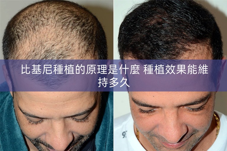 比基尼種植的原理是什麼 種植效果能維持多久