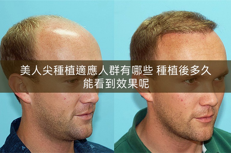 美人尖種植適應人群有哪些 種植後多久能看到效果呢