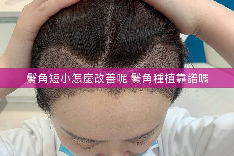鬢角短小怎麼改善呢 鬢角種植靠譜嗎