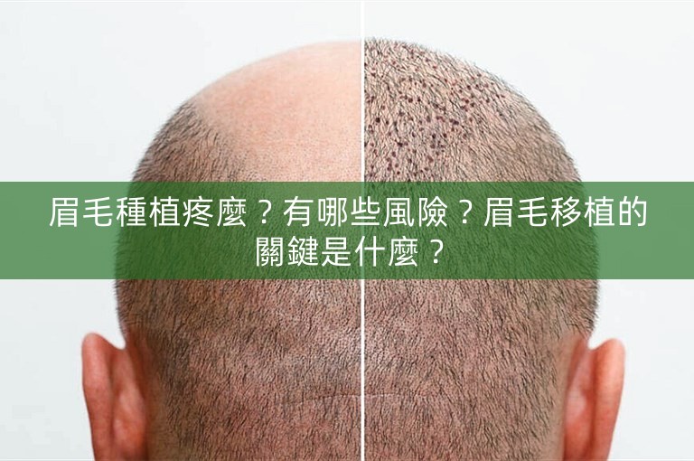 眉毛種植疼麼？有哪些風險？眉毛移植的關鍵是什麼？