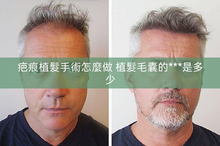 疤痕植髮手術怎麼做 植髮毛囊的***是多少