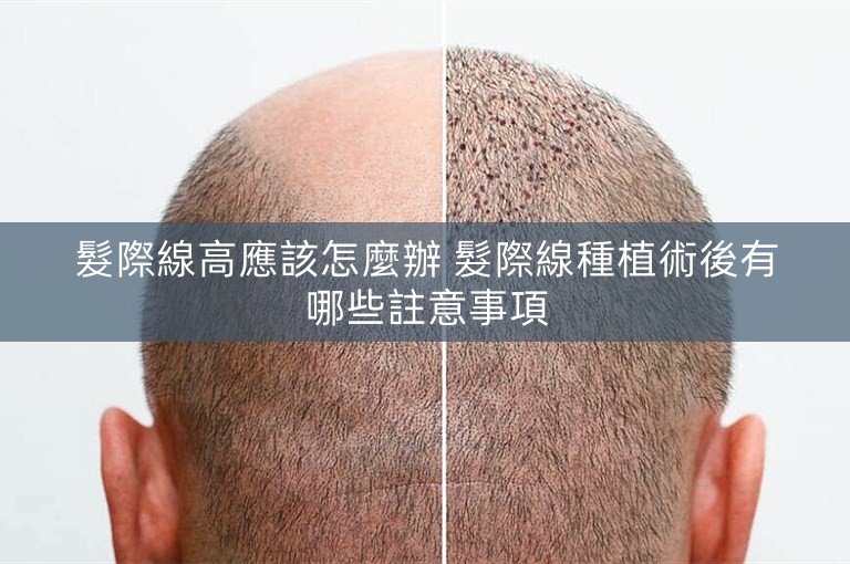 髮際線高應該怎麼辦 髮際線種植術後有哪些註意事項