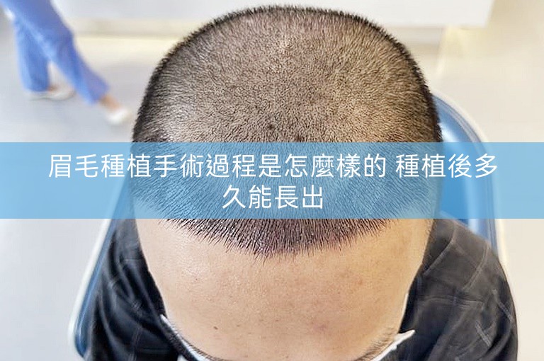 眉毛種植手術過程是怎麼樣的 種植後多久能長出