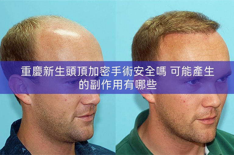 重慶新生頭頂加密手術安全嗎 可能產生的副作用有哪些