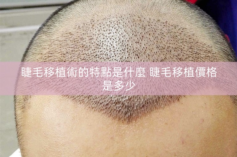 睫毛移植術的特點是什麼 睫毛移植價格是多少