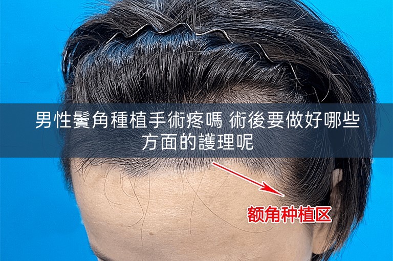男性鬢角種植手術疼嗎 術後要做好哪些方面的護理呢