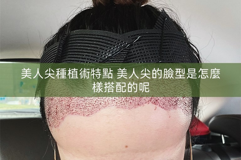 美人尖種植術特點 美人尖的臉型是怎麼樣搭配的呢