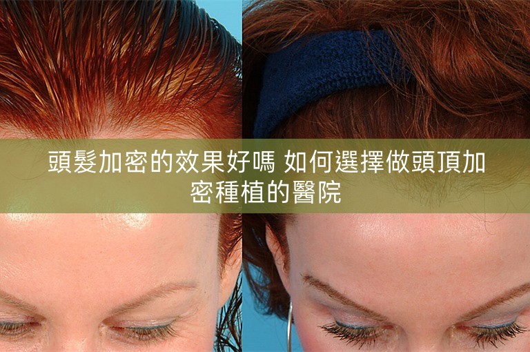 頭髮加密的效果好嗎 如何選擇做頭頂加密種植的醫院