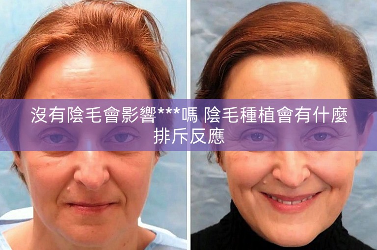 沒有陰毛會影響***嗎 陰毛種植會有什麼排斥反應