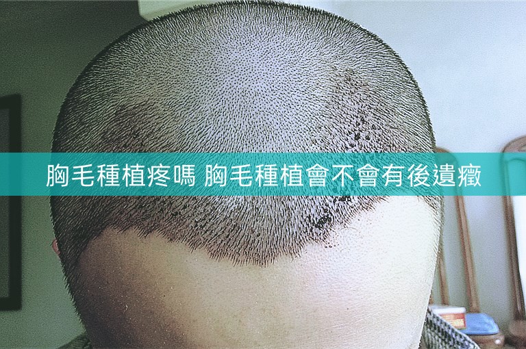 胸毛種植疼嗎 胸毛種植會不會有後遺癥 胸毛種植疼嗎 胸毛種植會不會有後遺癥