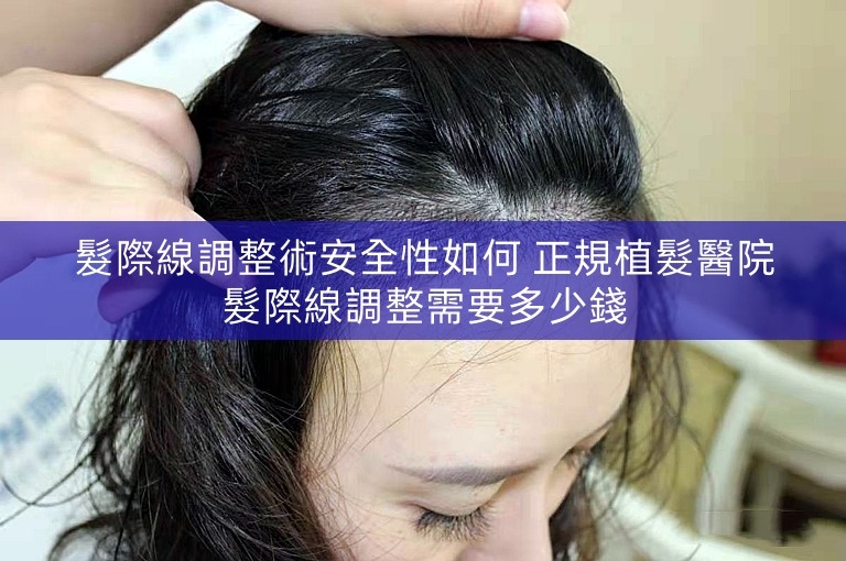 髮際線調整術安全性如何 正規植髮醫院髮際線調整需要多少錢
