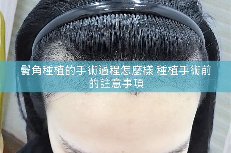鬢角種植的手術過程怎麼樣 種植手術前的註意事項