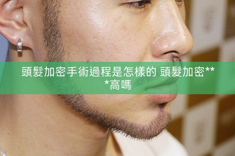 頭髮加密手術過程是怎樣的 頭髮加密***高嗎