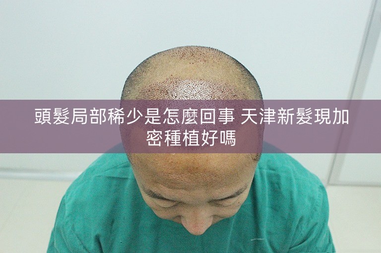 頭髮局部稀少是怎麼回事 天津新髮現加密種植好嗎