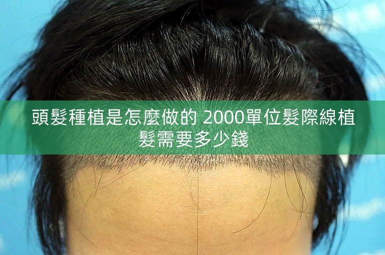 頭髮種植是怎麼做的 2000單位髮際線植髮需要多少錢