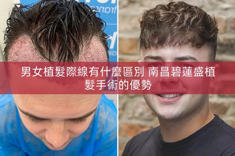 男女植髮際線有什麼區別 南昌碧蓮盛植髮手術的優勢