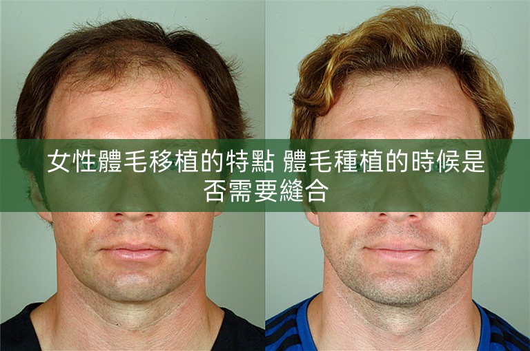 女性體毛移植的特點 體毛種植的時候是否需要縫合