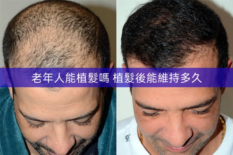 老年人能植髮嗎 植髮後能維持多久 老年人能植髮嗎 植髮後能維持多久