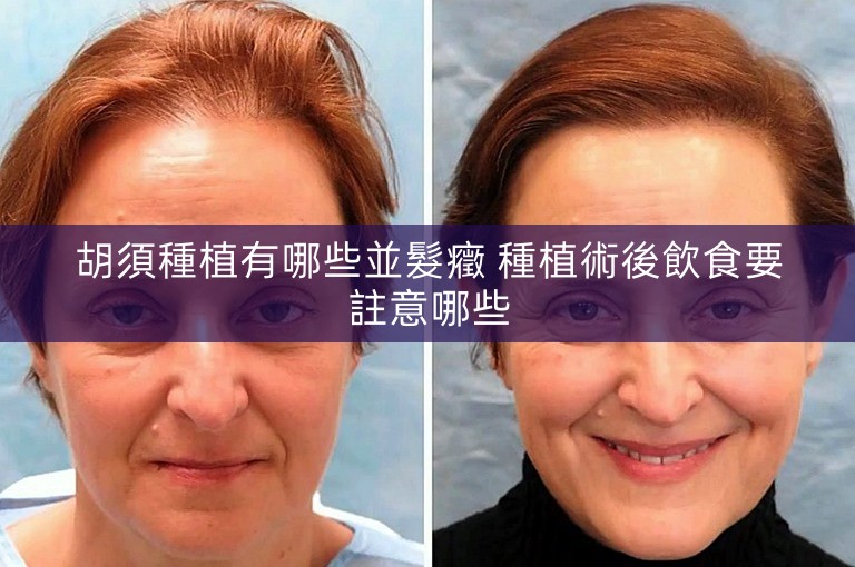 胡須種植有哪些並髮癥 種植術後飲食要註意哪些
