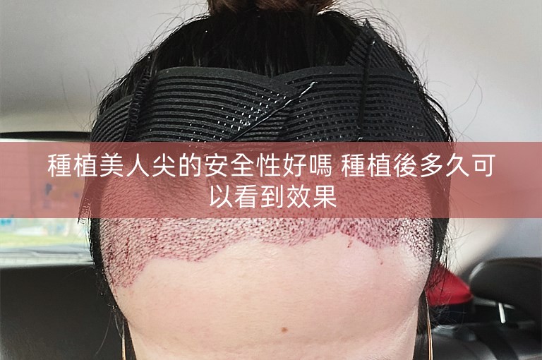 種植美人尖的安全性好嗎 種植後多久可以看到效果