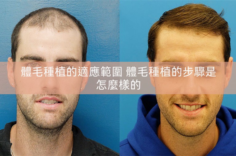 體毛種植的適應範圍 體毛種植的步驟是怎麼樣的