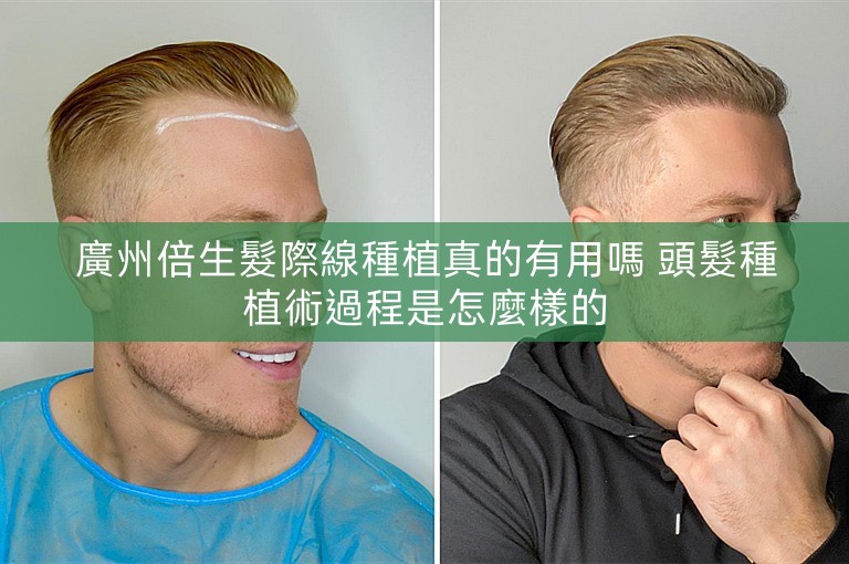 廣州倍生髮際線種植真的有用嗎 頭髮種植術過程是怎麼樣的