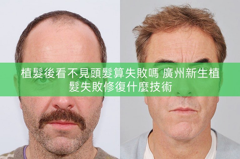 植髮後看不見頭髮算失敗嗎 廣州新生植髮失敗修復什麼技術
