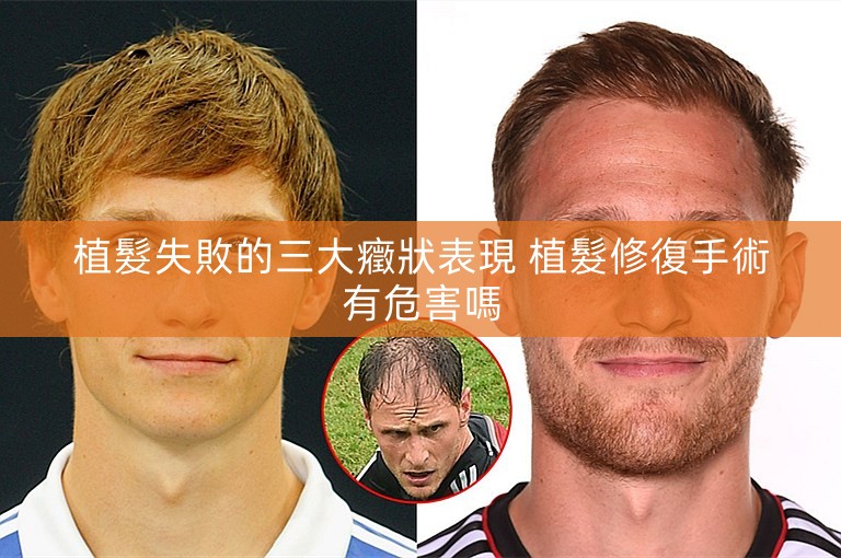 植髮失敗的三大癥狀表現 植髮修復手術有危害嗎