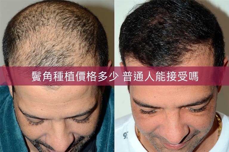 鬢角種植價格多少 普通人能接受嗎