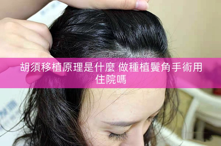 胡須移植原理是什麼 做種植鬢角手術用住院嗎