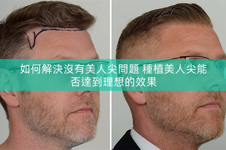 如何解決沒有美人尖問題 種植美人尖能否達到理想的效果