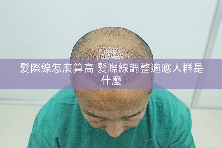 髮際線怎麼算高 髮際線調整適應人群是什麼
