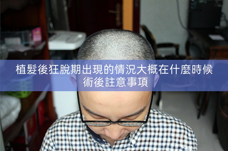 植髮後狂脫期出現的情況大概在什麼時候 術後註意事項