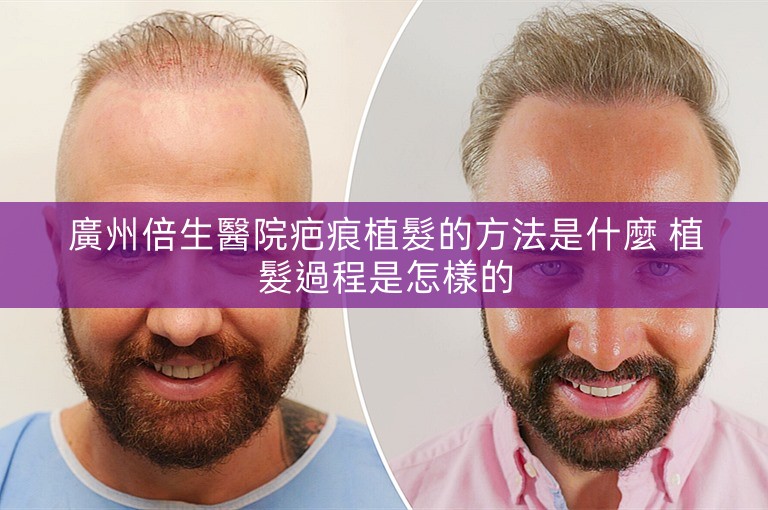 廣州倍生醫院疤痕植髮的方法是什麼 植髮過程是怎樣的