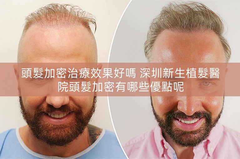 頭髮加密治療效果好嗎 深圳新生植髮醫院頭髮加密有哪些優點呢