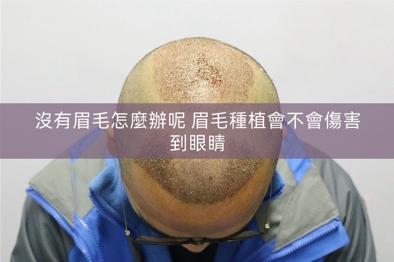 沒有眉毛怎麼辦呢 眉毛種植會不會傷害到眼睛