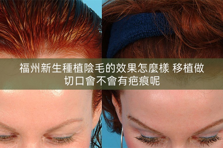 福州新生種植陰毛的效果怎麼樣 移植做切口會不會有疤痕呢