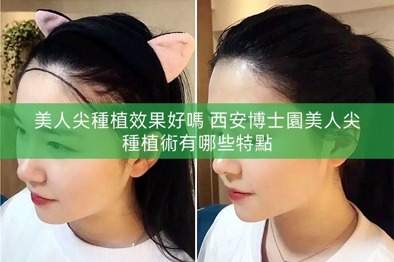 美人尖種植效果好嗎 西安博士園美人尖種植術有哪些特點