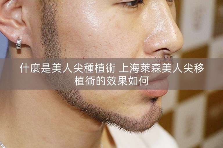 什麼是美人尖種植術 上海萊森美人尖移植術的效果如何