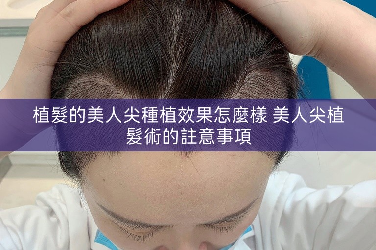 植髮的美人尖種植效果怎麼樣 美人尖植髮術的註意事項