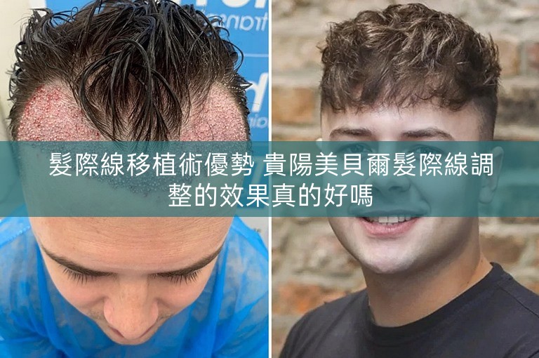 髮際線移植術優勢 貴陽美貝爾髮際線調整的效果真的好嗎