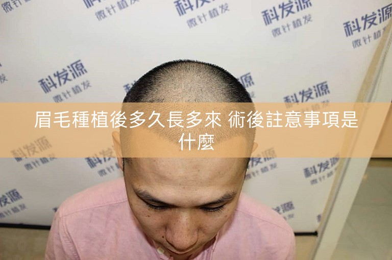 眉毛種植後多久長多來 術後註意事項是什麼