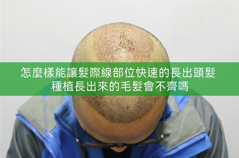 怎麼樣能讓髮際線部位快速的長出頭髮 種植長出來的毛髮會不齊嗎