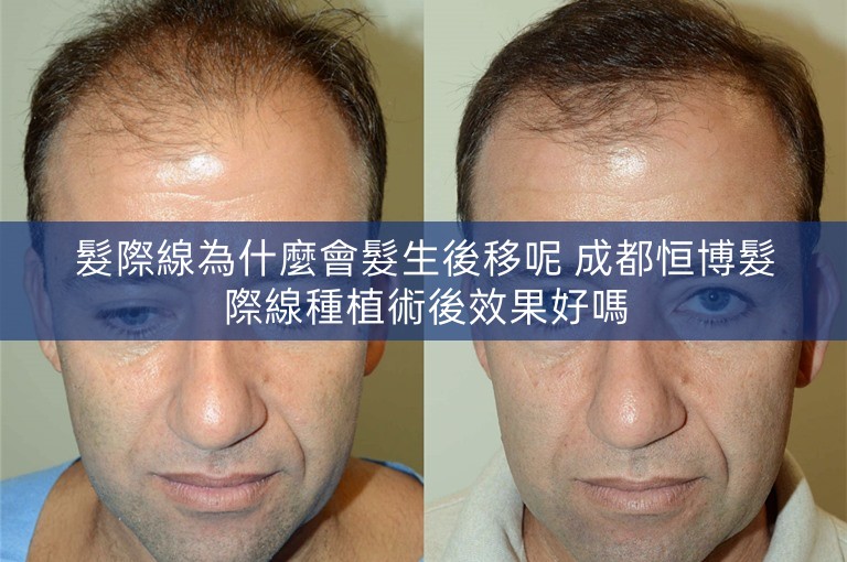 髮際線為什麼會髮生後移呢 成都恒博髮際線種植術後效果好嗎