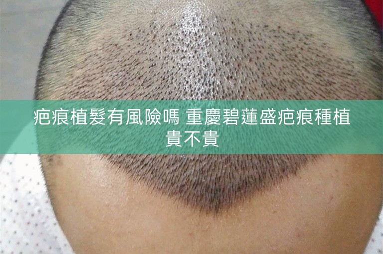 疤痕植髮有風險嗎 重慶碧蓮盛疤痕種植貴不貴