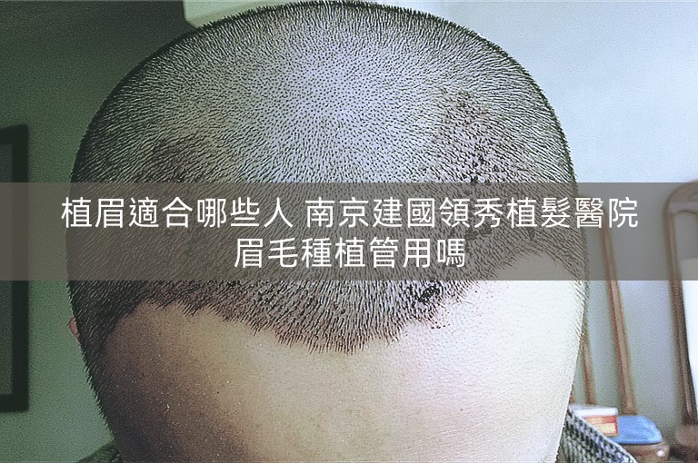 植眉適合哪些人 南京建國領秀植髮醫院眉毛種植管用嗎