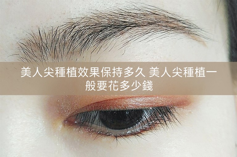 美人尖種植效果保持多久 美人尖種植一般要花多少錢