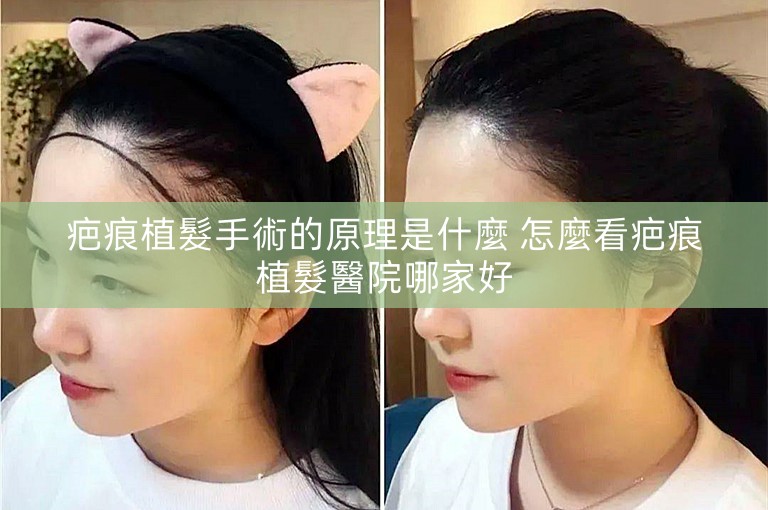 疤痕植髮手術的原理是什麼 怎麼看疤痕植髮醫院哪家好