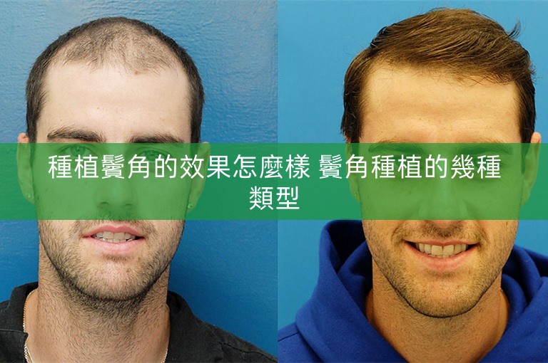 種植鬢角的效果怎麼樣 鬢角種植的幾種類型